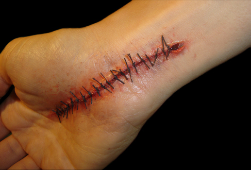 Cicatricure, sutura